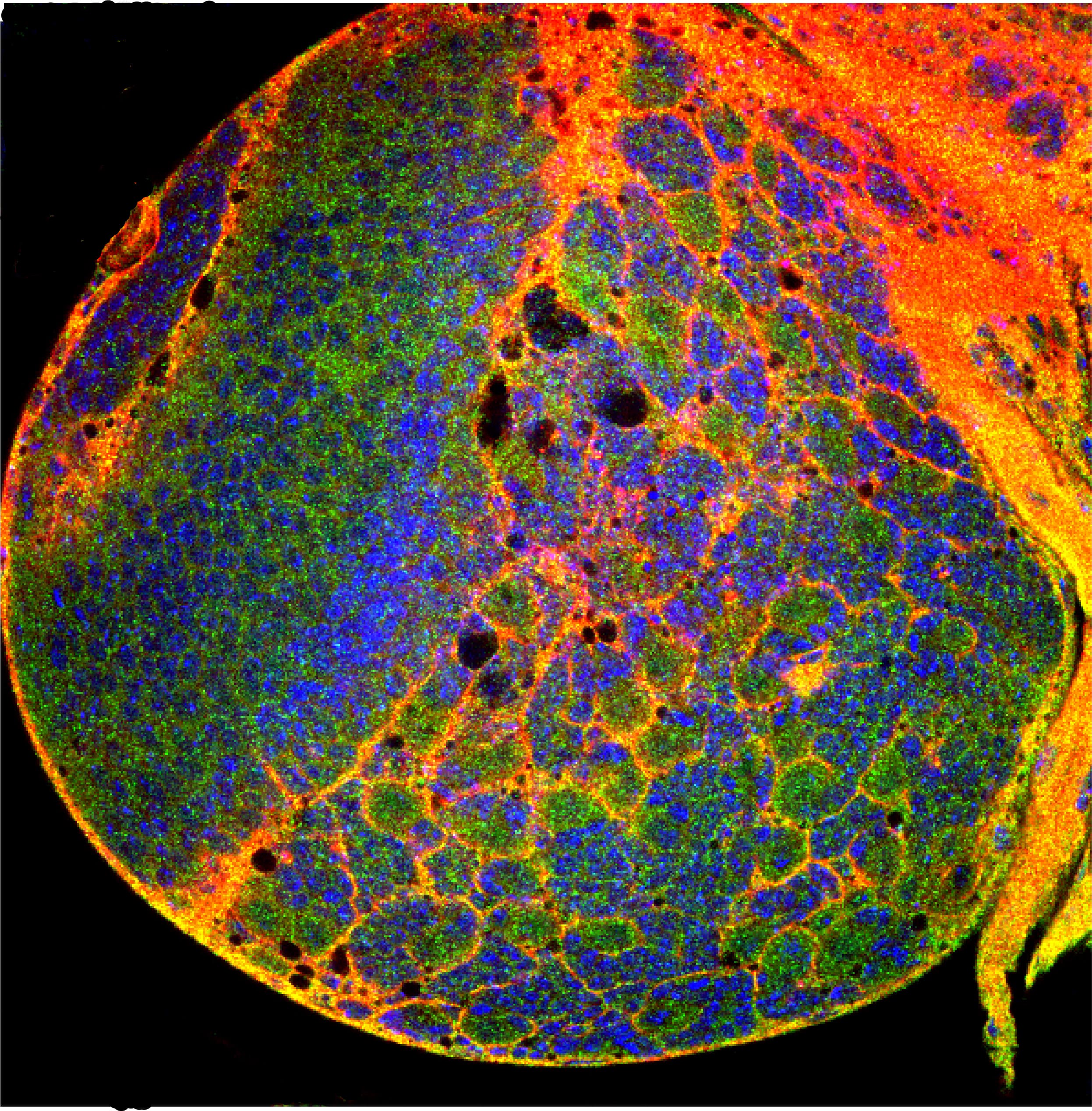 Un estudi de l’IRBLleida i la UdL, identifica una nova diana terapèutica potencial contra el glioblastoma, un tipus de tumor cerebral